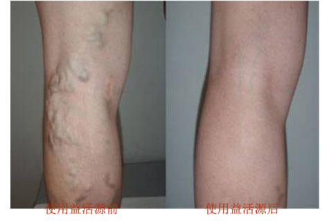 明星静脉曲张,明星静脉曲张的奇妙日常